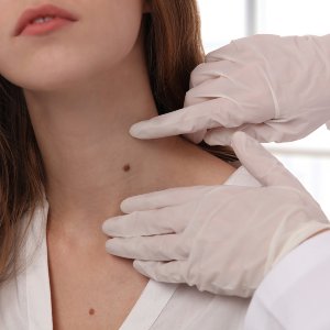 Birthmarks Treatment Near Me in New York, NY