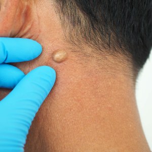 Cyst Excisions Near Me in New York, NY
