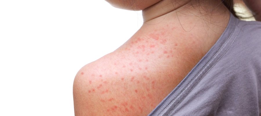 Drug-Induced Rashes at Donnelley Dermatology, PLLC in New York, NY