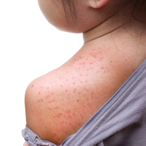 Drug-Induced Rashes Treatment Near Me in New York, NY