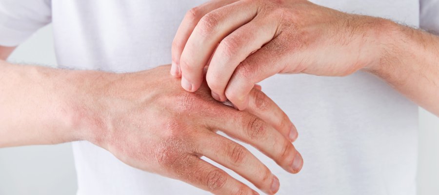 Eczema at Donnelley Dermatology, PLLC in New York, NY Eczema at Donnelley Dermatology, PLLC in New York, NY