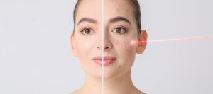 Fraxel Laser at Donnelley Dermatology, PLLC in New York, NY