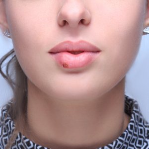 Herpes Infections Treatment Near Me in New York, NY