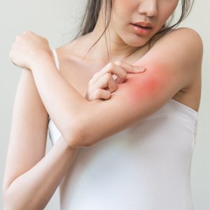 Hives Treatment Near Me in New York, NY