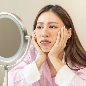 Melasma Treatment Near Me in New York, NY