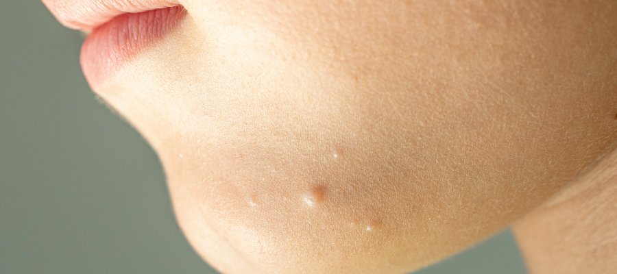 Molluscum Contagiosum at Donnelley Dermatology, PLLC in New York, NY Molluscum Contagiosum at Donnelley Dermatology, PLLC in New York, NY