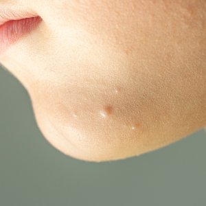 Molluscum Contagiosum Treatment Near Me in New York, NY
