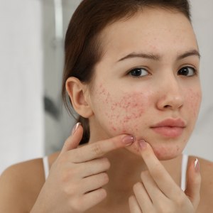 Rosacea Treatment Near Me in New York, NY