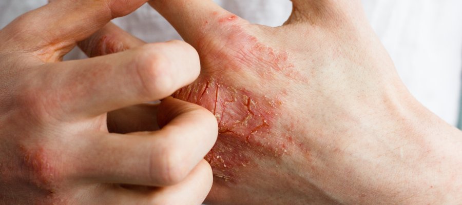 Seborrheic Dermatitis at Donnelley Dermatology, PLLC in New York, NY