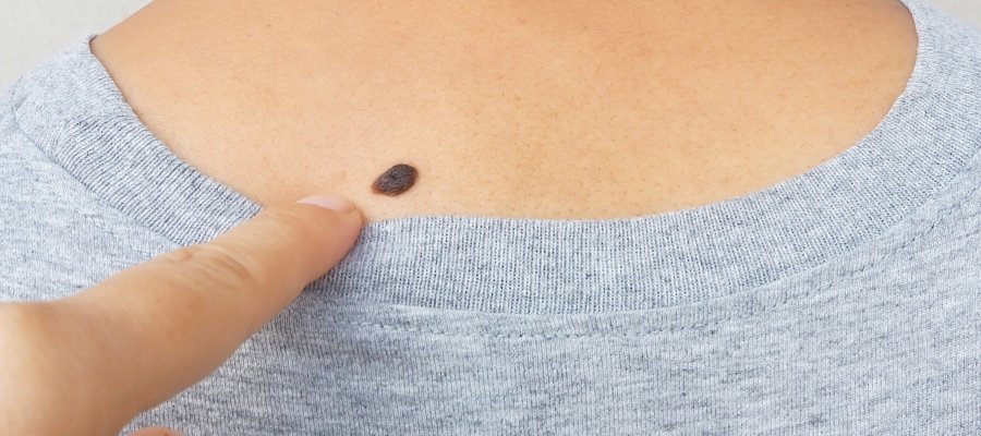 Seborrheic Keratoses at Donnelley Dermatology, PLLC in New York, NY Seborrheic Keratoses at Donnelley Dermatology, PLLC in New York, NY