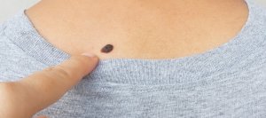 Seborrheic Keratoses at Donnelley Dermatology, PLLC in New York, NY Seborrheic Keratoses at Donnelley Dermatology, PLLC in New York, NY