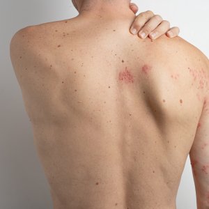 Shingles Treatment Near Me in New York, NY