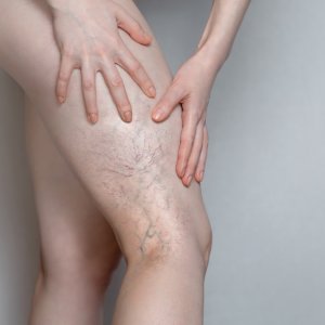 Venous Statis Dermatitis Treatment Near Me in New York, NY