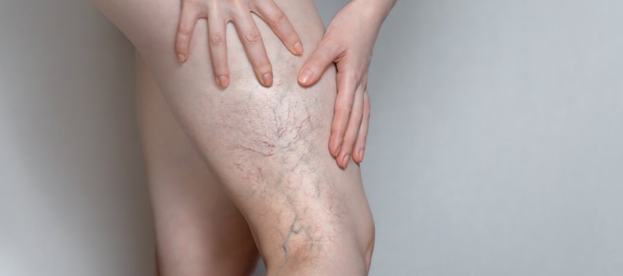 Venous Statis Dermatitis at Donnelley Dermatology, PLLC in New York, NY