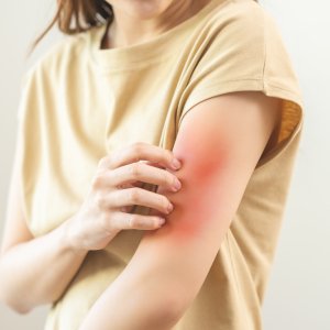 Viral Rashes Treatment Near Me in New York, NY