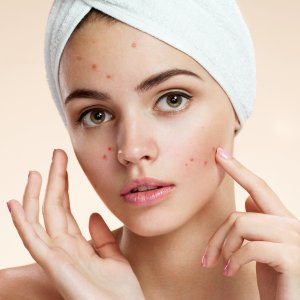 Acne Treatment Near Me in New York, NY
