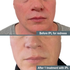 After 1 treatment of IPL for Redness Before & After of Donnelley Dermatology, PLLC in New York, NY