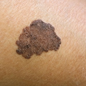 Melanoma Treatment Near Me in New York, NY