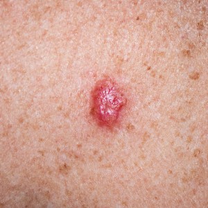 Basal Cell Carcinoma (BCC) Treatment Near Me in New York, NY