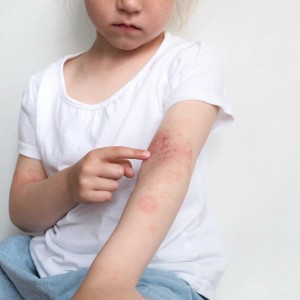 Pediatric Eczema Treatment Near Me in New York, NY