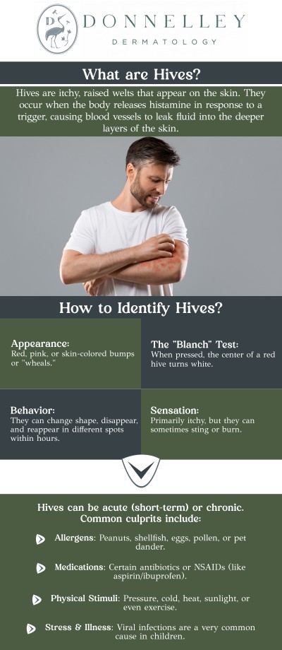Common questions asked by patients: What are hives? What causes hives to appear? What are the symptoms of hives? What is the most effective treatment for hives? Are hives contagious? How are hives diagnosed? When should I seek medical care for hives? Hives, also known as urticaria, are raised, red, itchy welts that appear on the skin due to an allergic reaction or other triggers. These welts can vary in size and may appear suddenly, often causing discomfort. Dr. Naomi Donnelley, MD, FAAD, a board-certified dermatologist, offers personalized treatments for hives at Donnelley Dermatology, PLLC in New York, NY, to help alleviate symptoms and prevent future outbreaks. With a tailored treatment plan, patients can experience relief and manage their condition effectively. For more information, contact us or schedule an appointment online. We are conveniently located at 1075 Park Ave , #1C, New York, NY, 10128.