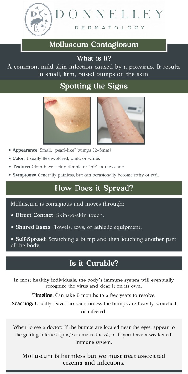 Common questions asked by patients: What is Molluscum Contagiosum? How does Molluscum Contagiosum spread? What are the symptoms of Molluscum Contagiosum? Is Molluscum Contagiosum contagious? How is Molluscum Contagiosum diagnosed? Molluscum Contagiosum is a viral skin infection that causes small, raised, round bumps on the skin. It spreads through direct contact or by sharing personal items, and is most common in children but can affect adults as well. Dr. Naomi S. Donnelley, a board-certified dermatologist at Donnelley Dermatology, PLLC, offers effective treatment options to manage and treat Molluscum Contagiosum. For more information, contact us or schedule an appointment online. We are conveniently located at 1075 Park Ave , #1C, New York, NY, 10128. Common questions asked by patients: What is Molluscum Contagiosum? How does Molluscum Contagiosum spread? What are the symptoms of Molluscum Contagiosum? Is Molluscum Contagiosum contagious? How is Molluscum Contagiosum diagnosed? Molluscum Contagiosum is a viral skin infection that causes small, raised, round bumps on the skin. It spreads through direct contact or by sharing personal items, and is most common in children but can affect adults as well. Dr. Naomi S. Donnelley, a board-certified dermatologist at Donnelley Dermatology, PLLC, offers effective treatment options to manage and treat Molluscum Contagiosum. For more information, contact us or schedule an appointment online. We are conveniently located at 1075 Park Ave , #1C, New York, NY, 10128.