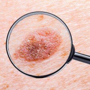 Squamous Cell Carcinoma (SCC) Treatment Near Me in New York, NY