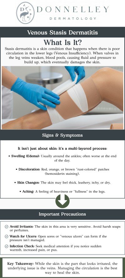 Common questions asked by patients: What is venous stasis dermatitis? What causes venous stasis dermatitis? How is venous stasis dermatitis diagnosed? What are the symptoms of venous stasis dermatitis? How is venous stasis dermatitis treated? How long does it take to heal venous stasis dermatitis? Venous stasis dermatitis is a skin condition that occurs when poor circulation in the lower legs causes blood to pool, leading to skin irritation, redness, and swelling. It is commonly seen in people with chronic venous insufficiency or varicose veins. Dr. Naomi Donnelley, MD, FAAD, a board-certified dermatologist, offers effective treatments for venous stasis dermatitis at Donnelley Dermatology, PLLC in New York, NY. Treatment focuses on improving circulation, reducing inflammation, and preventing further skin damage. For more information, contact us or schedule an appointment online. We are conveniently located at 1075 Park Ave , #1C, New York, NY, 10128.